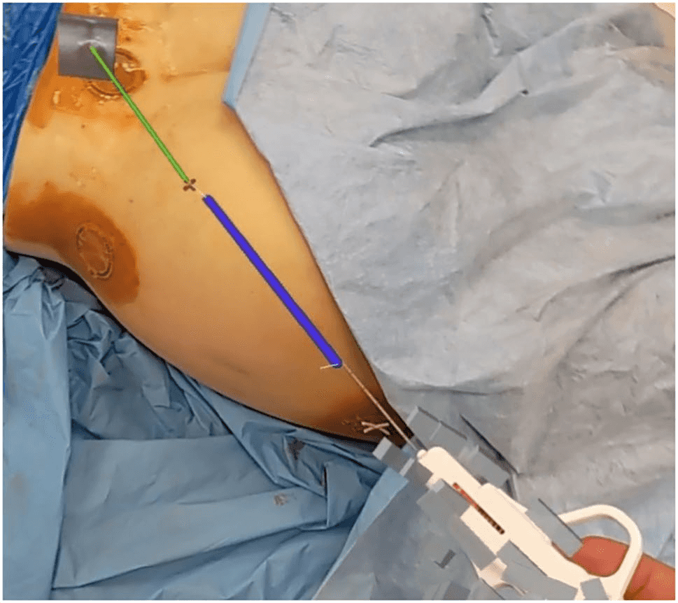 Biopsy needle navigation seen through the mixed reality headset