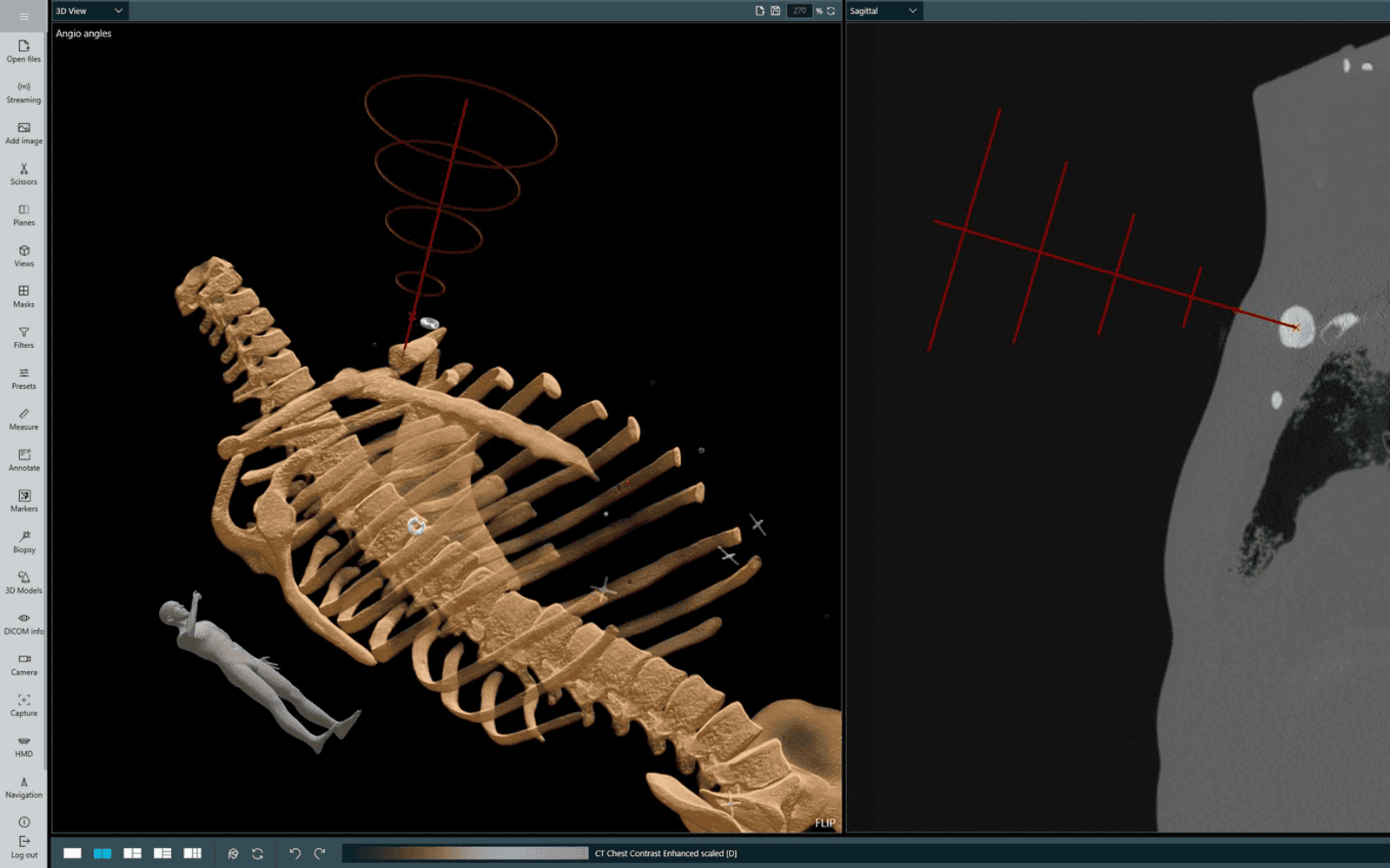 Needle trajectory planning in CarnaLife Holo MedNav — a 3D chest model beside a sagittal CT slice