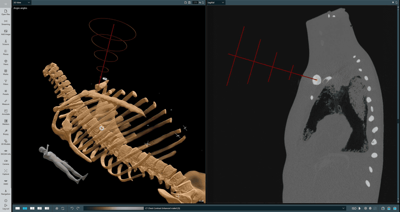 Planning a biopsy trajectory in the CarnaLife Holo software