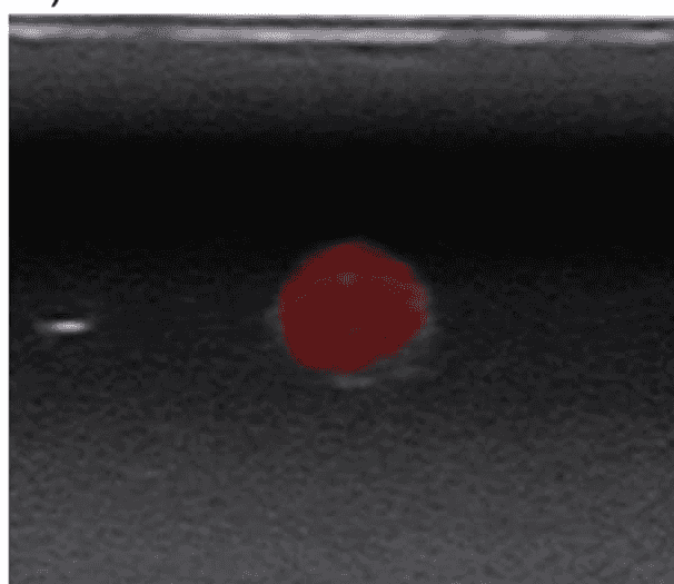 Fusion of the ultrasound image with the lesion contour from CT